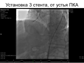 A koszorúér-stent beültetést idős betegeknél - a sajtószolgálat KazNMU