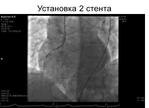 Stentul arterelor coronare la pacienții vârstnici - serviciul de presă al trezoreriei