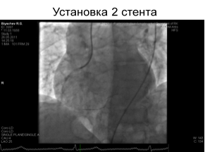 Стентування коронарних артерій у хворих похилого віку - прес-служба КазНМУ