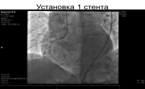 A koszorúér-stent beültetést idős betegeknél - a sajtószolgálat KazNMU