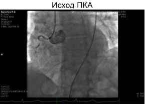 A koszorúér-stent beültetést idős betegeknél - a sajtószolgálat KazNMU