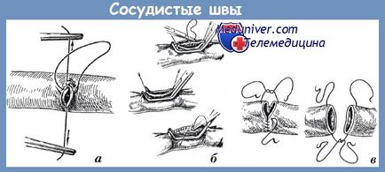 Техніка операції при пораненні судин шиї - хірургічна тактика