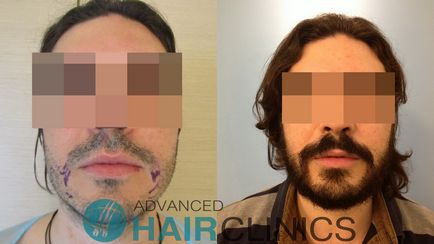 Transplant de barbă, clinici avansate de păr