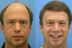 Трансплантація волосся від чого залежить успішність трансплантації