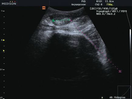 Diagnosticul cu ultrasunete la naștere - Terugulova l