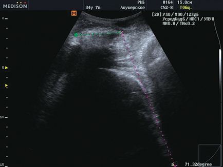 Diagnosticul cu ultrasunete la naștere - Terugulova l