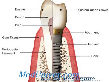 Пристрій зубних імплантатів