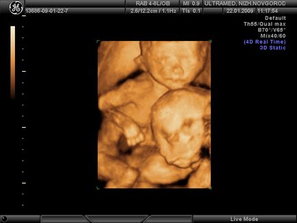 Fetal cu ultrasunete (în timpul sarcinii) (2), 