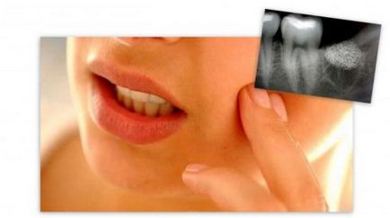Dintele sfâșiat, gingia durează ce trebuie să facă și cum trebuie tratată