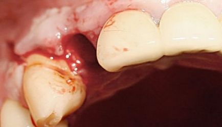 Dintele sfâșiat, gingia durează ce trebuie să facă și cum trebuie tratată