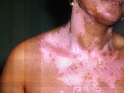 Vitiligo cauzele, diagnosticul, tratamentul