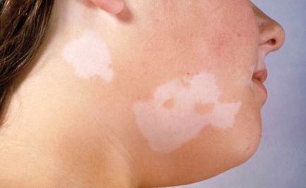 Vitiligo cauzele, diagnosticul, tratamentul