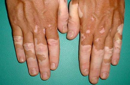 Vitiligo cauzele, diagnosticul, tratamentul