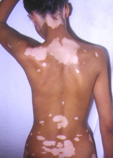 Vitiligo cauzele, diagnosticul, tratamentul