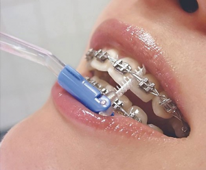 Віск для брекетів - можливо кращий сайт про лікування зубів