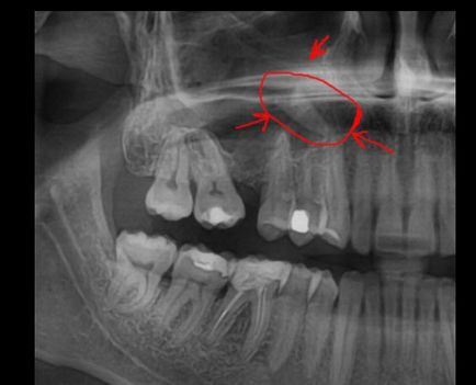 Sebészi kezelése odontogén sinusitis, fistula műanyag alján a maxilláris szinuszok,