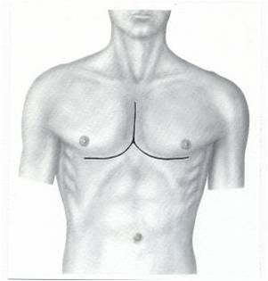 Хірургія деформацій грудної клітини