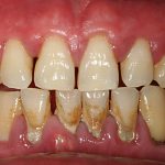 Krónikus periodontitis tünetei, okai és kezelése