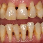 Krónikus periodontitis tünetei, okai és kezelése