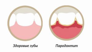 Krónikus periodontitis tünetei, okai és kezelése