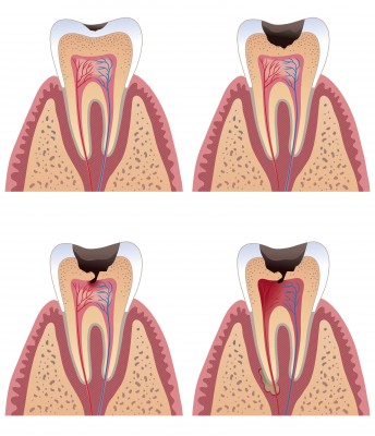 Krónikus pulpitis típusú, a tünetek, a kezelés