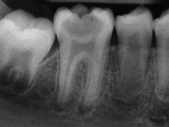 Krónikus pulpitis típusú, a tünetek, a kezelés