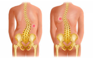 Lansat osteochondrosis, simptome și tratament