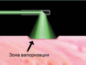 Зелений лазер - «green light laser» лікування аденоми простати, uronews