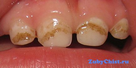Placa galbenă a dinților copilului cauzează și modalități eficiente de a le elimina
