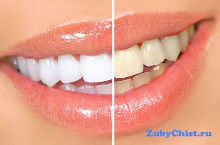 Placa galbenă a dinților copilului cauzează și modalități eficiente de a le elimina