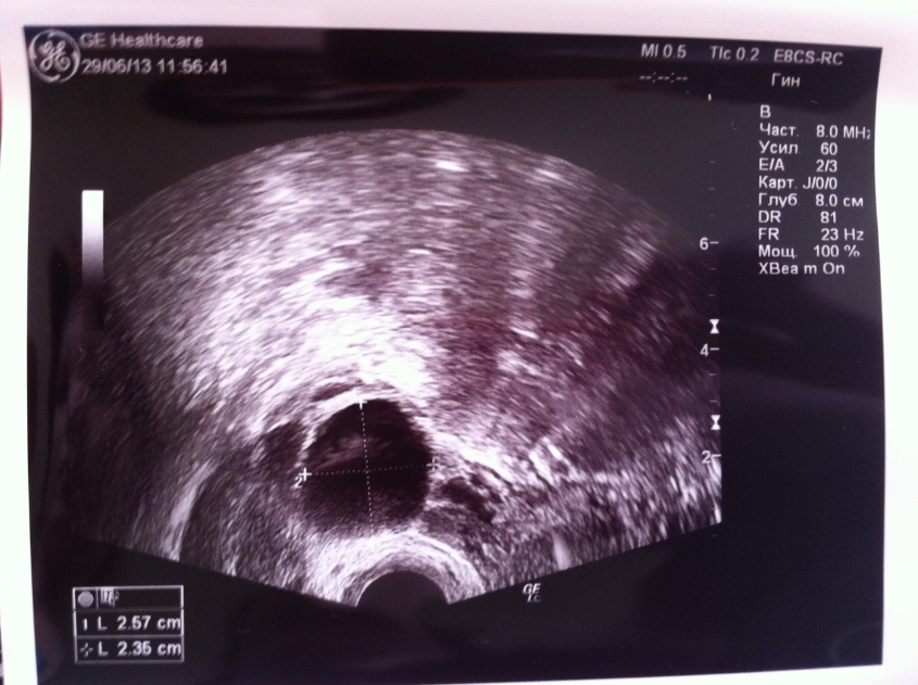 Corp galben în ovar în timpul sarcinii - în dreapta și în stânga, formarea chisturilor