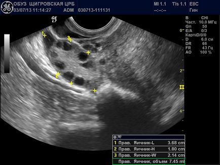 Corp galben în ovar în timpul sarcinii - în dreapta și în stânga, formarea chisturilor