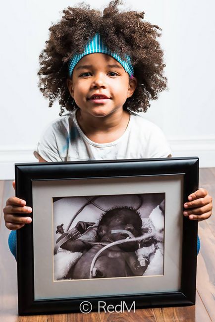 15 Puternici - înainte și după - fotografii ale copiilor prematuri