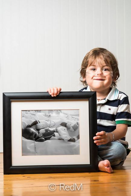 15 Потужних - до і після - фотографій недоношених дітей