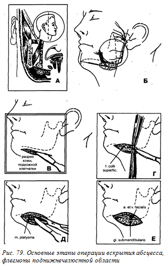 Абсцес, флегмона піднижньощелепної області - хороший стоматологічний портал, хороший