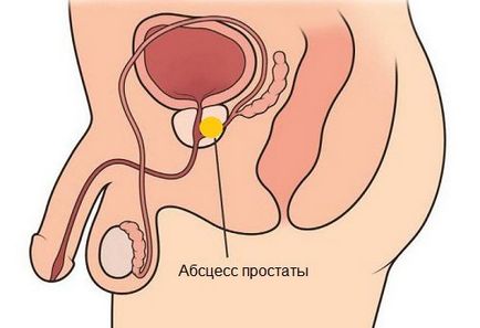 Абсцес простати (передміхурової залози) - симптоми і лікування захворювання