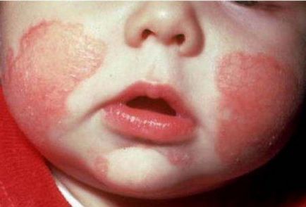 Diateza alergică la copii simptomele și tratamentul - viața mea