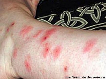 Alergii pentru a mușca simptomele mucoasei, tratament