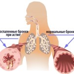 Антибіотики при бронхіальній астмі у дорослих назви препаратів