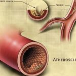 Атеросклероз аорти черевної аорти симптоми клініка, лікування