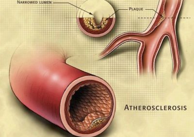 Ateroscleroza aortei simptomelor aortei abdominale ale clinicii, tratament