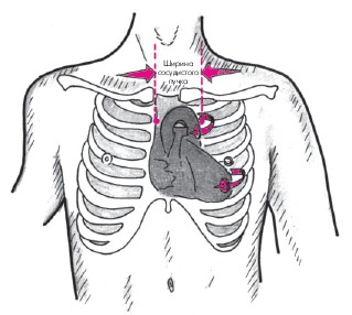 Атеросклероз грудної аорти атеросклероз аорти відноситься до числа найбільш частих локалізацій