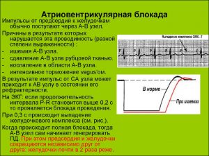 Атріовентрикулярна блокада - причини, ступеня, симптоми, лікування