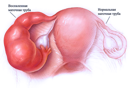 Infertilitatea tubal