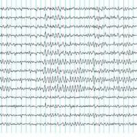 Simptomele bolii Parkinson, diagnosticul, semnele