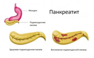 Біль в шлунку і відрижка повітрям - причини, симптоми, лікування