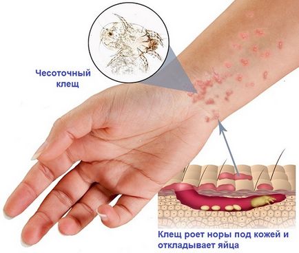 Scabie simptome, tratament, semne, medicamente și remediu la adulți