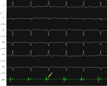 Transderofagiană, electrocardiografie, simptome de aritmie și tratament în Belarus