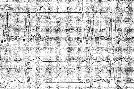 Transzözofageális elektrokardiogramm (chpekg) - vizsgálati módszerek betegek aritmiák és blokádok