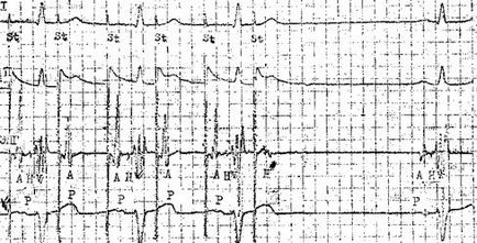 Electrocardiograma transesofagiană (chpekg) - metode de studiu a pacienților cu aritmii și blocade